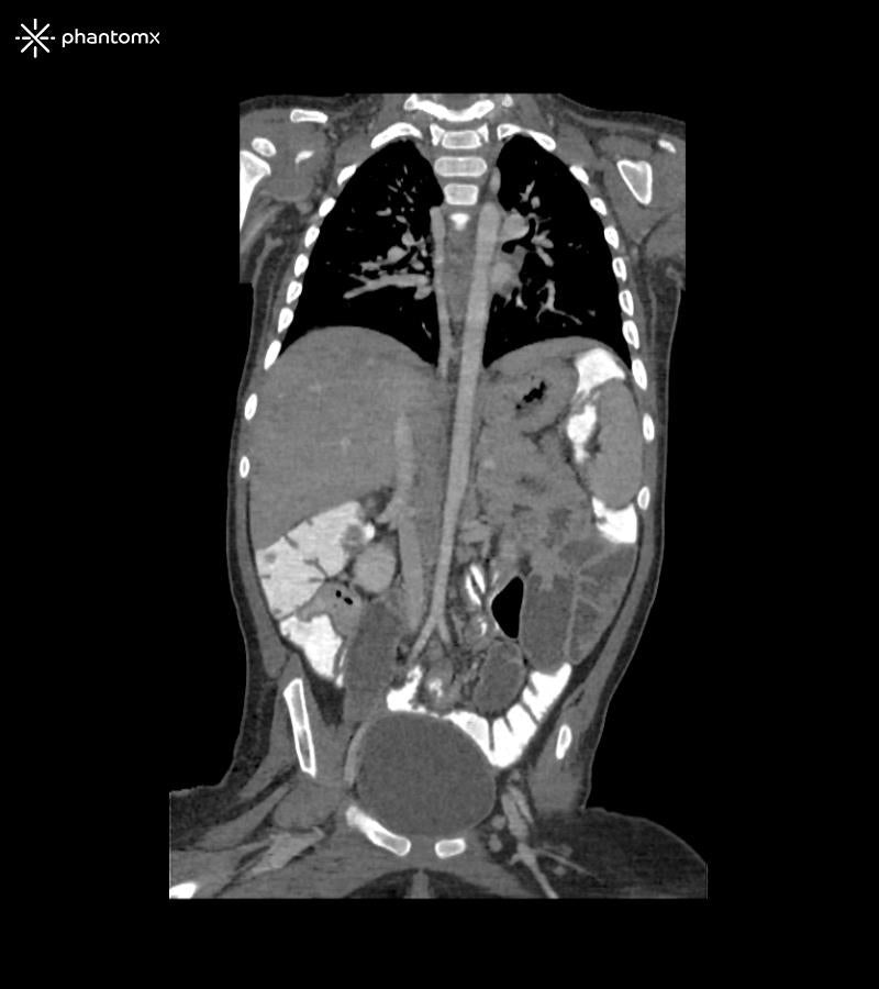 Anatomy Phantom Models for CT,  X-Ray, and Radiation Therapy