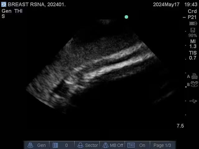 Adult Breast (Complex) for X-Ray CT, US, MRI BT-A01 Image 14