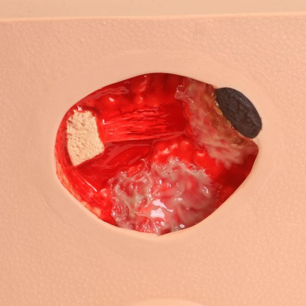 Stage 4 Pressure Sore Model With Exposed Bone & Osteomyelitis