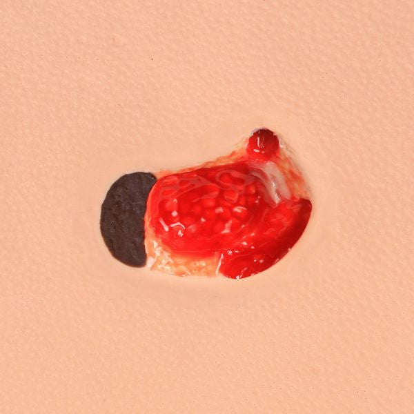 Undermining & Eschar Details on Stage 3 Pressure Injury Model