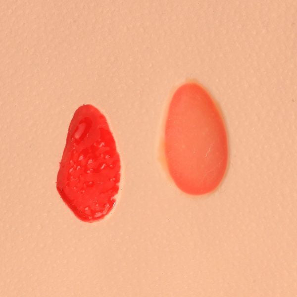 Bliser & Stage 2 Pressure Ulcer Training Model