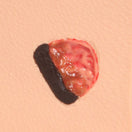 Switch Unstageable Wound on Pressure Injury Model 3 image