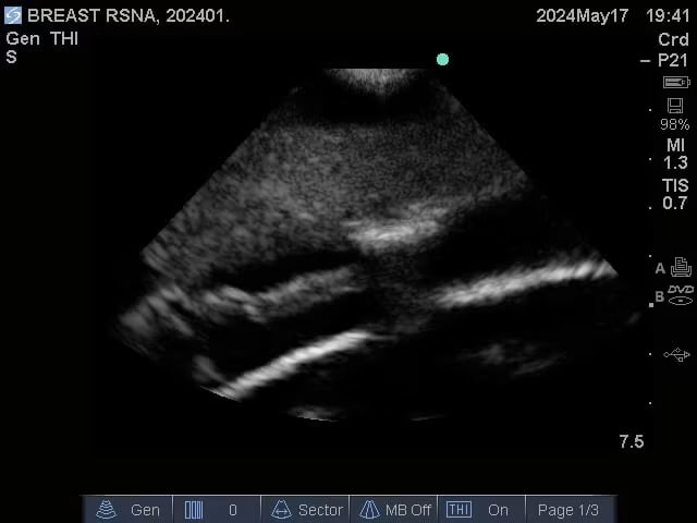 Adult Breast Phantom (Complex) for X-Ray CT, US, MRI
