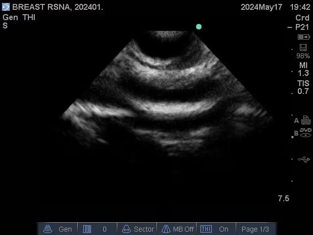 Adult Breast Phantom (Complex) for X-Ray CT, US, MRI