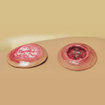 Set of 2 Decubitus Ulcers