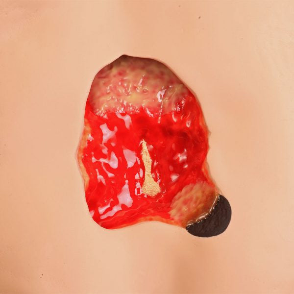 Stan Stage 4 Sacral Pressure Injury Model