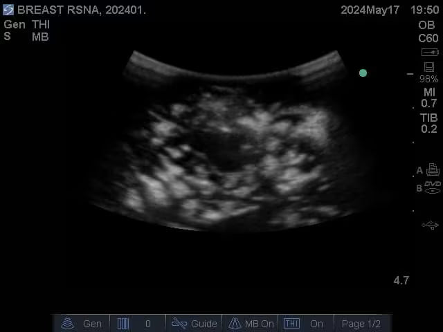 Adult Breast Phantom (Complex) for X-Ray CT, US, MRI
