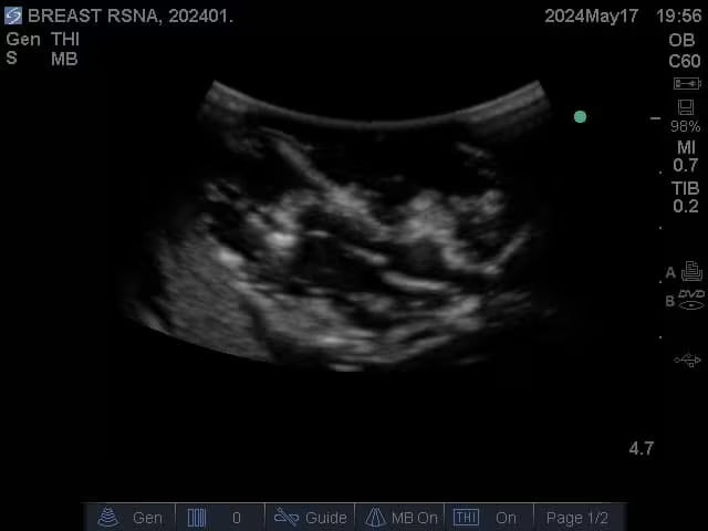 Adult Breast Phantom (Complex) for X-Ray CT, US, MRI
