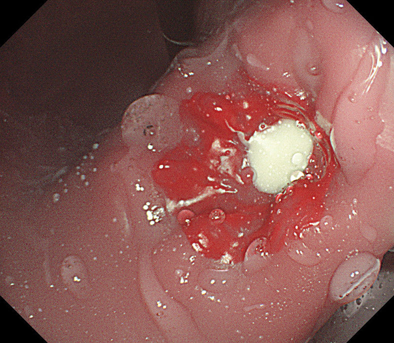 EsophagoGastroDuodenoscopy (EGD) Simulator