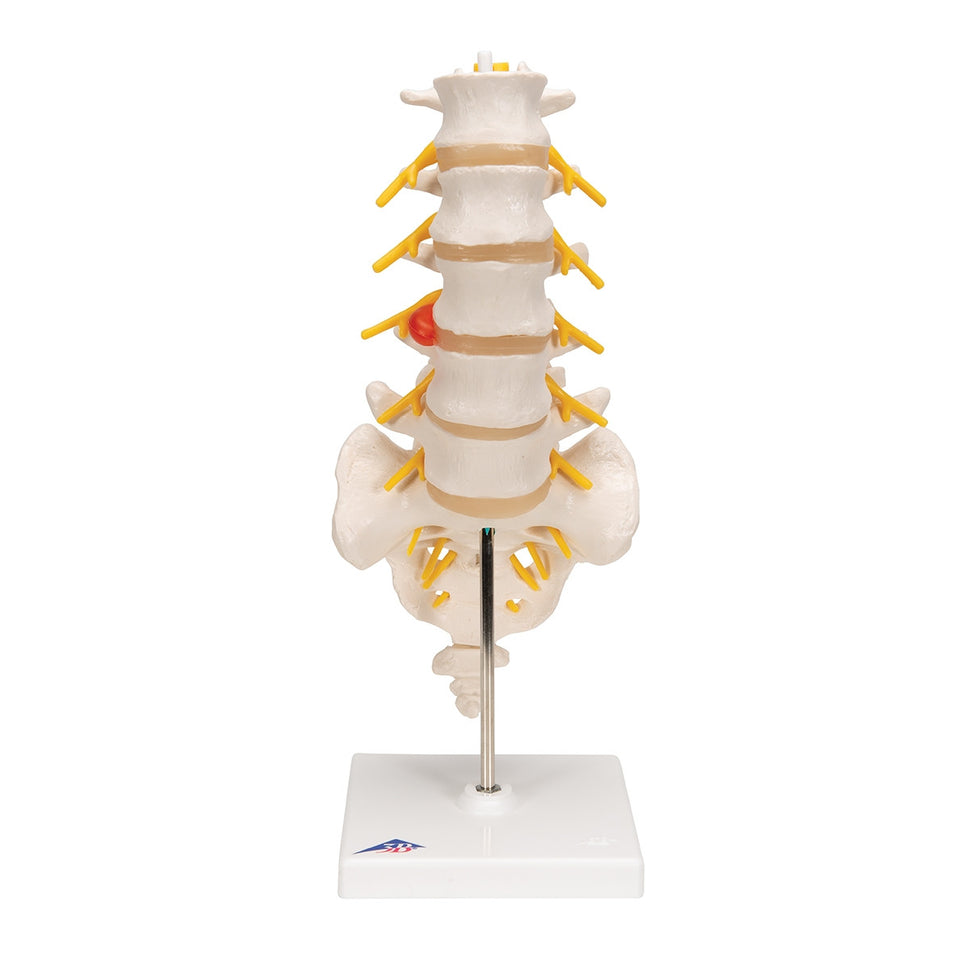 Lumbar Spine Model With Herniated Disc