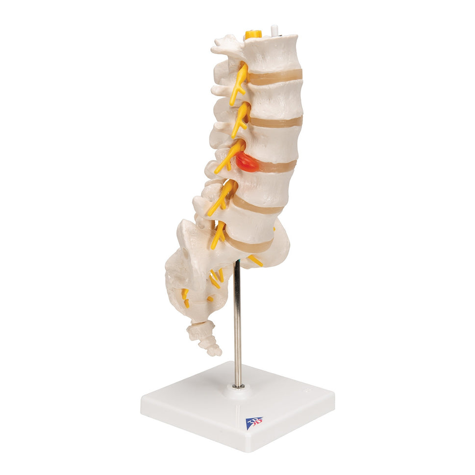 Lumbar Spine Model With Herniated Disc