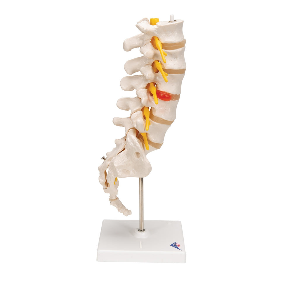 Lumbar Spine Model With Herniated Disc