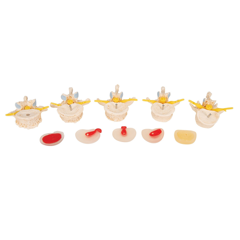 Spine Degeneration Model