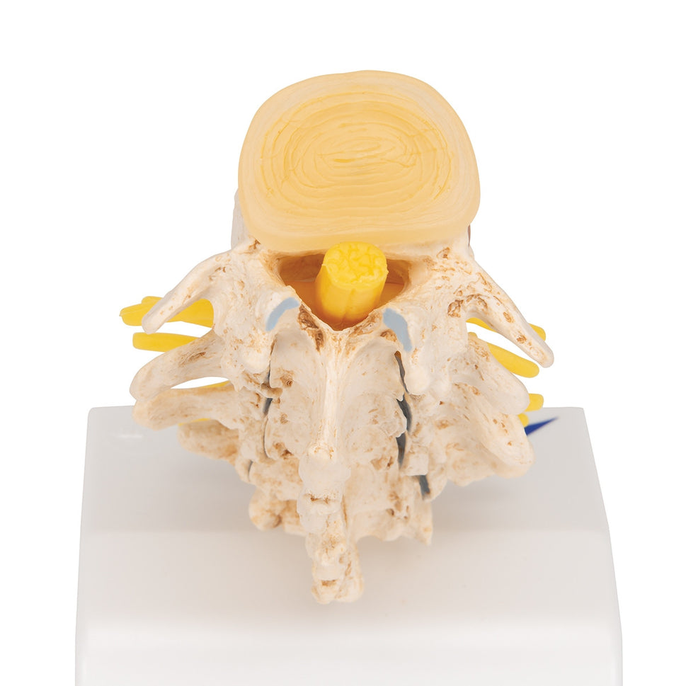 Spine Degeneration Model