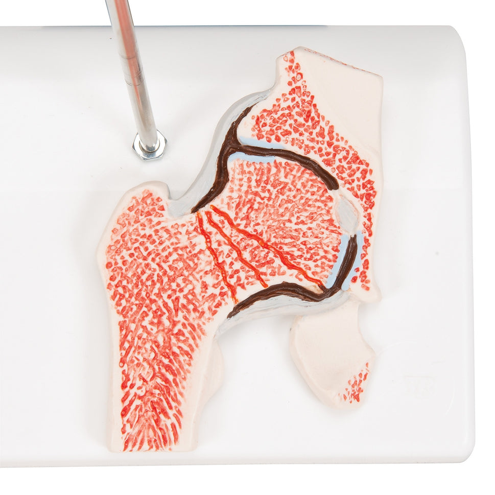 Femoral Fracture and Hip Osteoarthritis Model