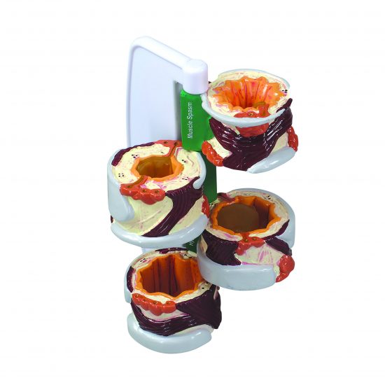 Bronchus Model 3120 Separated view