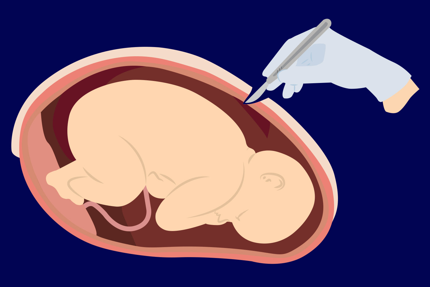 C-Section Aftercare
