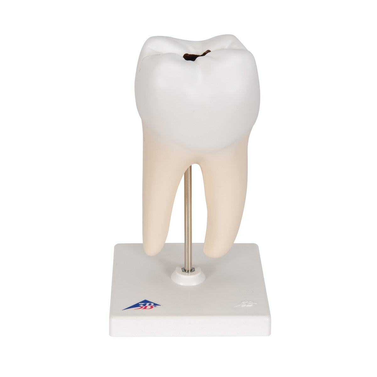 Lower Twin-Root Molar Model showing Cavities (2 part)