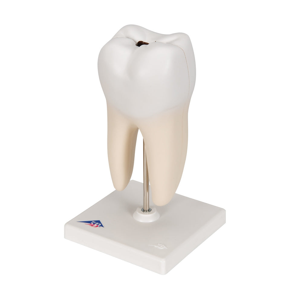 Lower Twin-Root Molar Model showing Cavities (2 part)