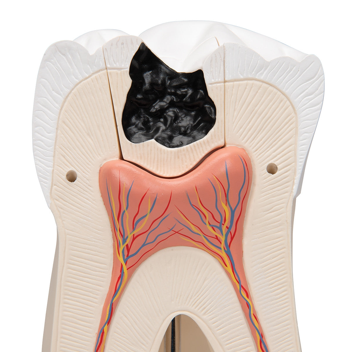 Giant Molar Model with Dental Cavities (15 times life size, 5 part)
