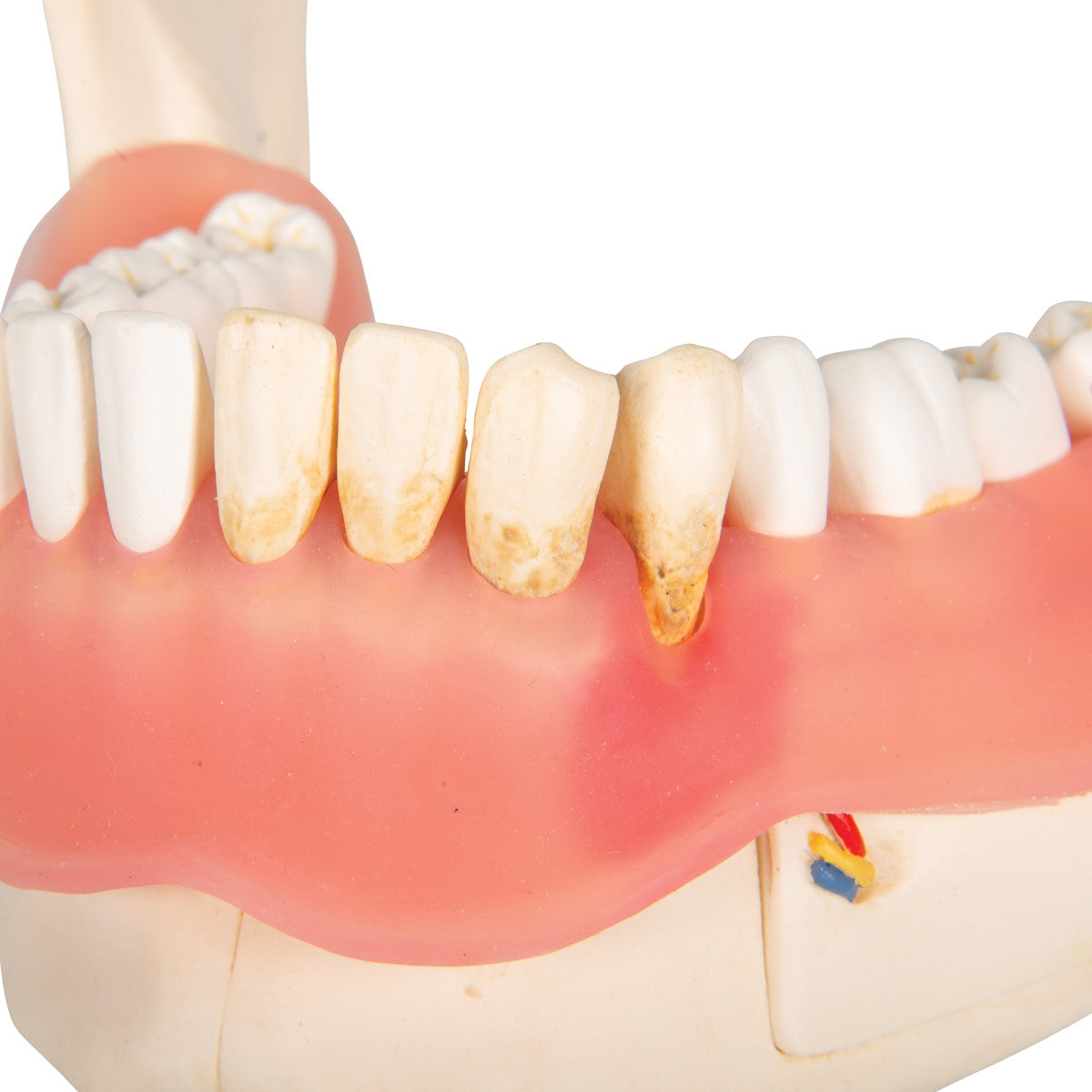 Dental Disease Model (2 times life size, 21 parts)