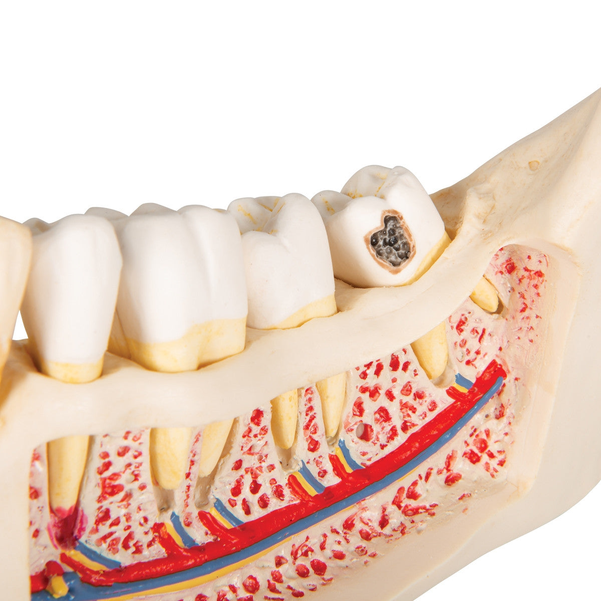 Dental Disease Model (2 times life size, 21 parts)