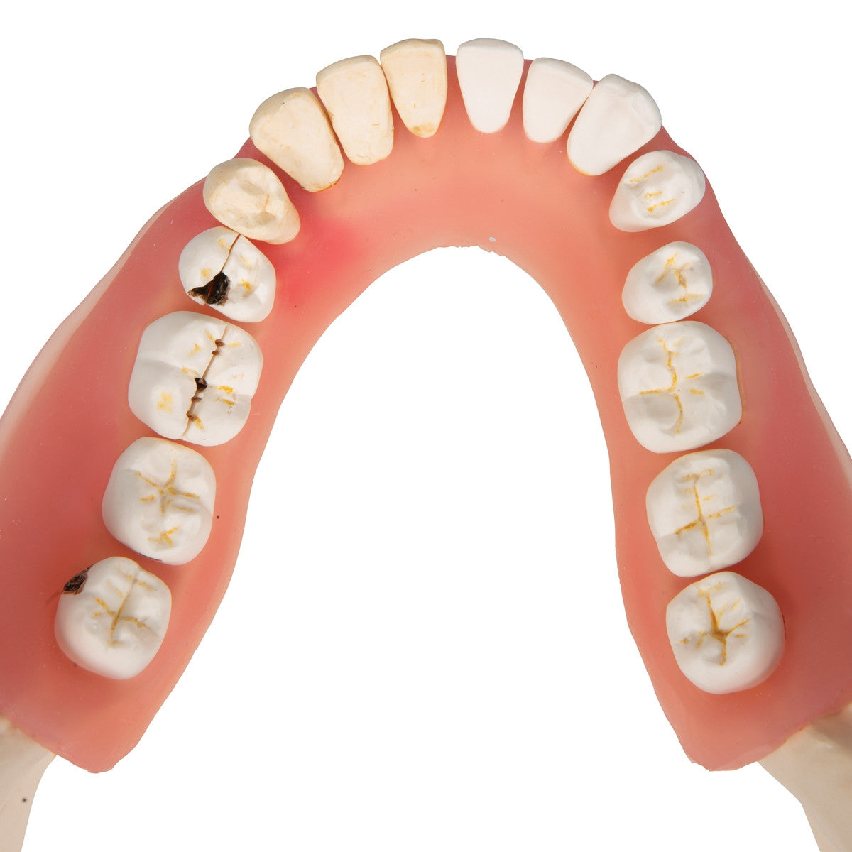 Dental Disease Model (2 times life size, 21 parts)