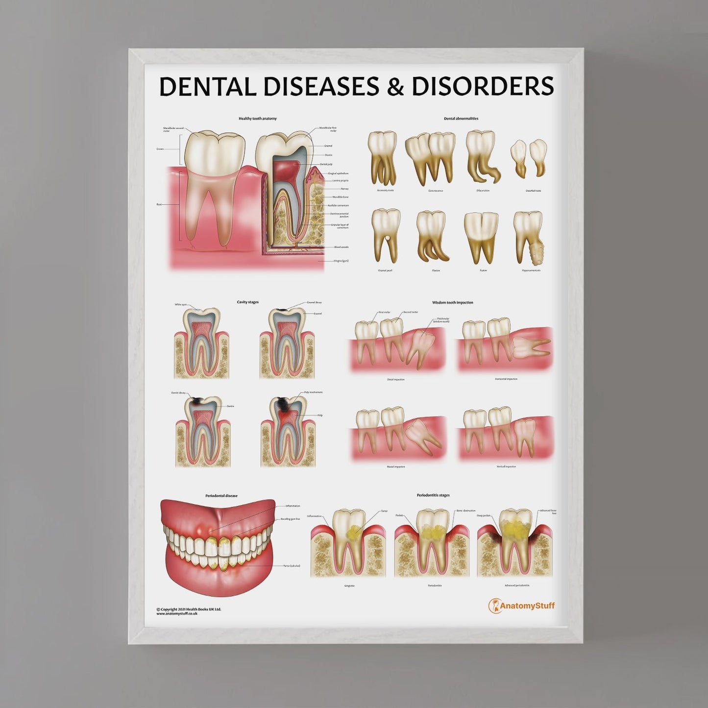 Dental Diseases & Disorders Chart / Poster - Part of Collection