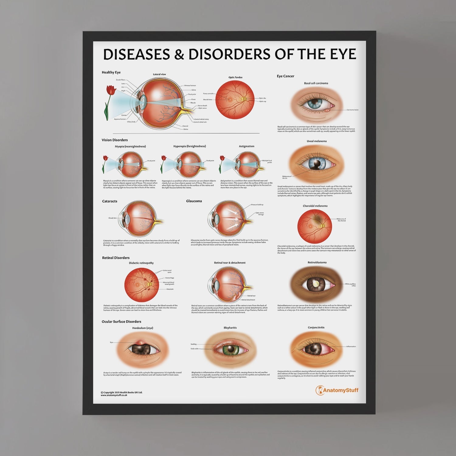 Diseases and Disorders of the Eye Chart / Poster - Part of Collection