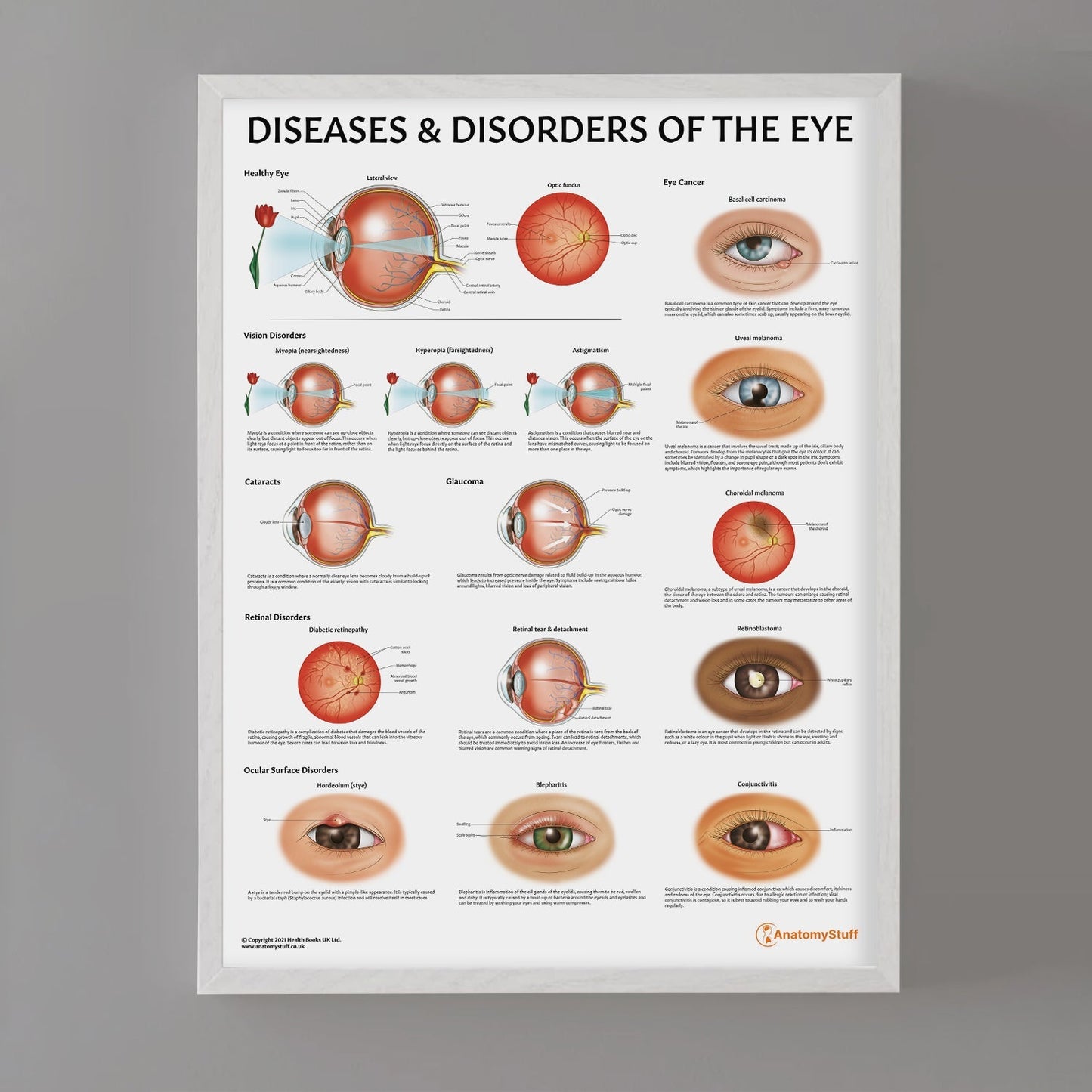Diseases and Disorders of the Eye Chart / Poster - Part of Collection