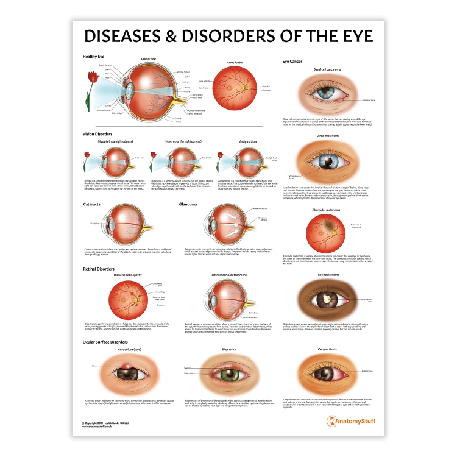 Diseases and Disorders of the Eye Chart / Poster - Part of Collection