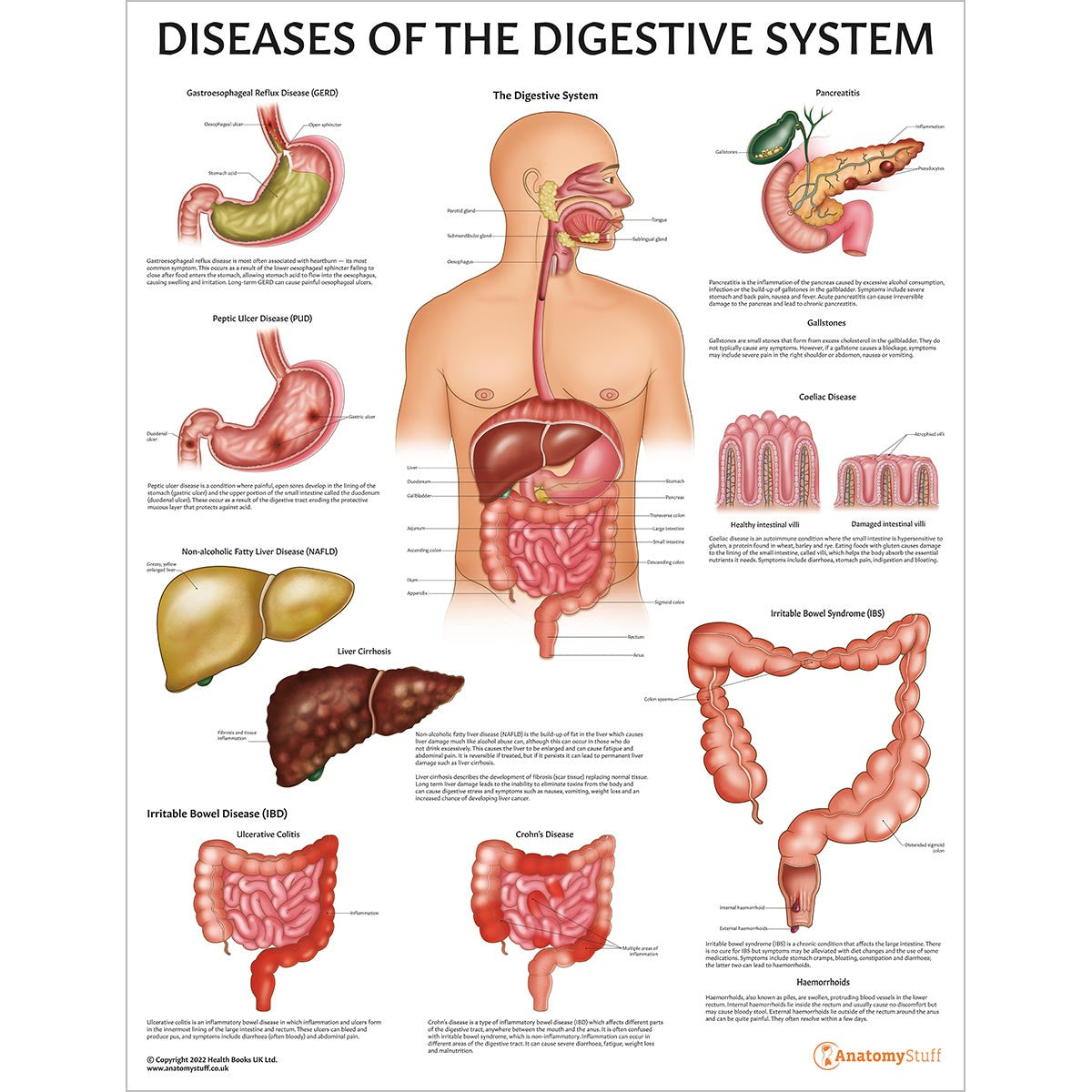 Diseases of the Digestive System Chart / Poster - Part of Collection