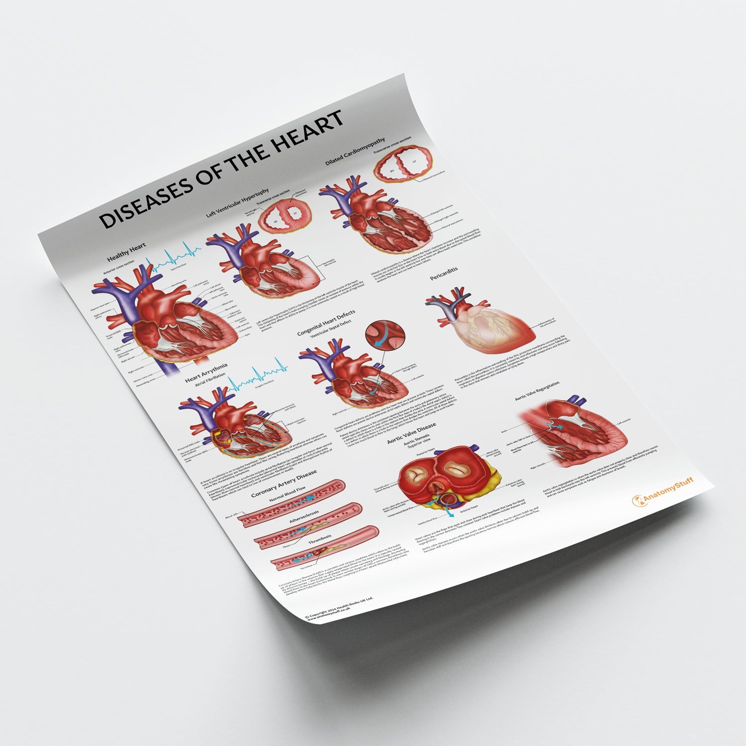 Diseases of the Heart Chart / Poster - Part of Collection