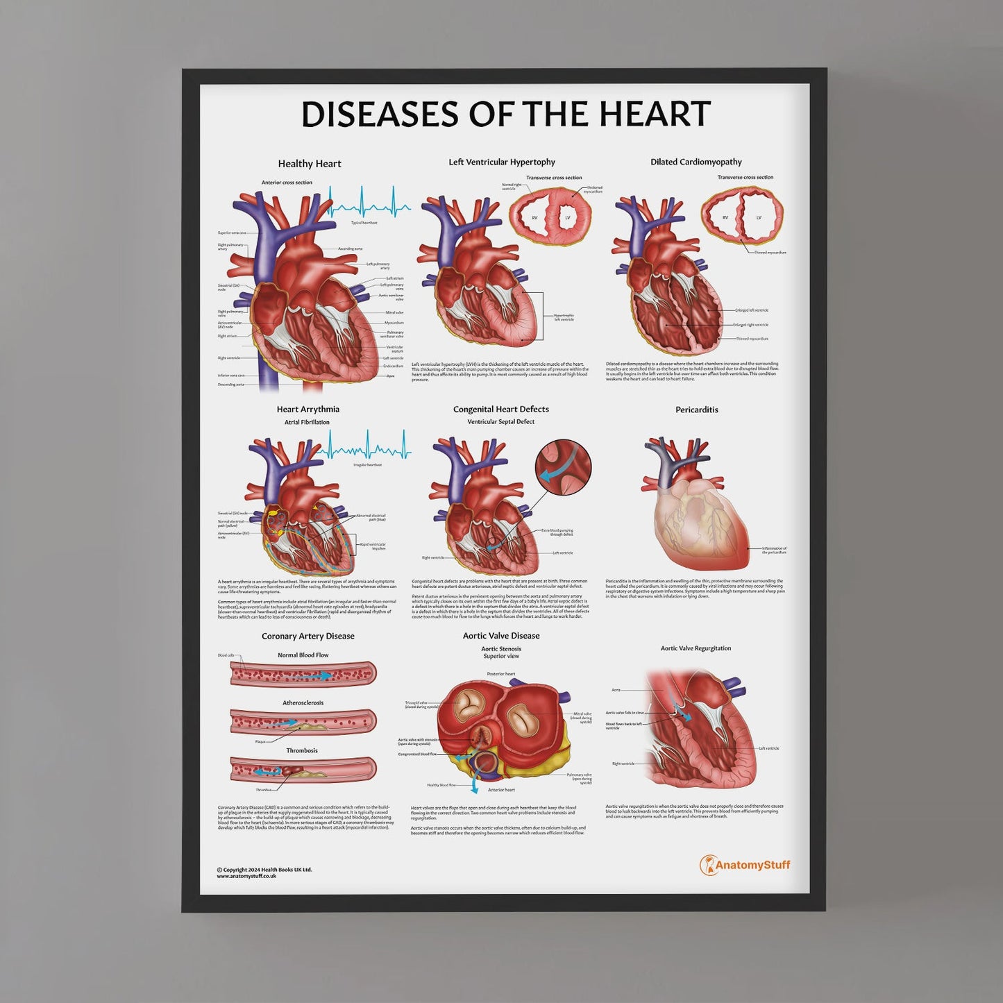 Diseases of the Heart Chart / Poster - Part of Collection