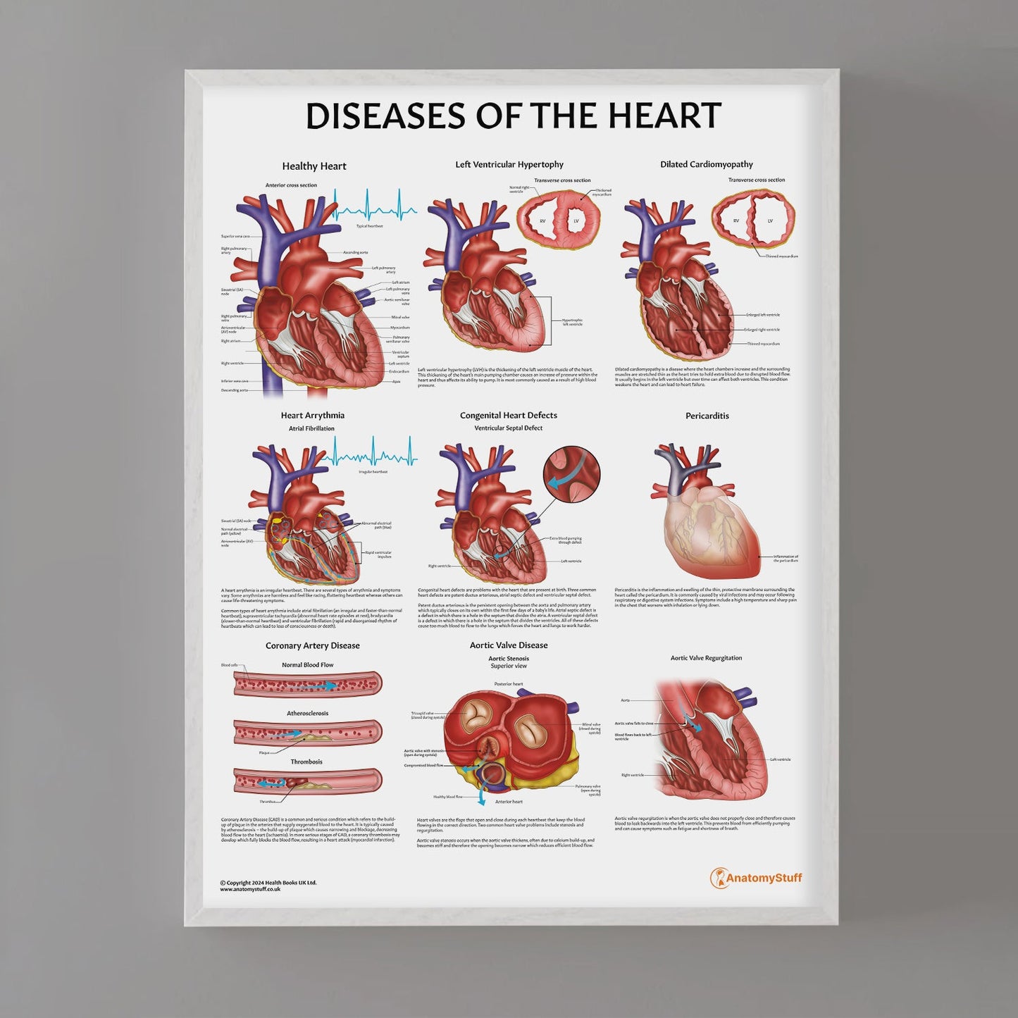 Diseases of the Heart Chart / Poster - Part of Collection