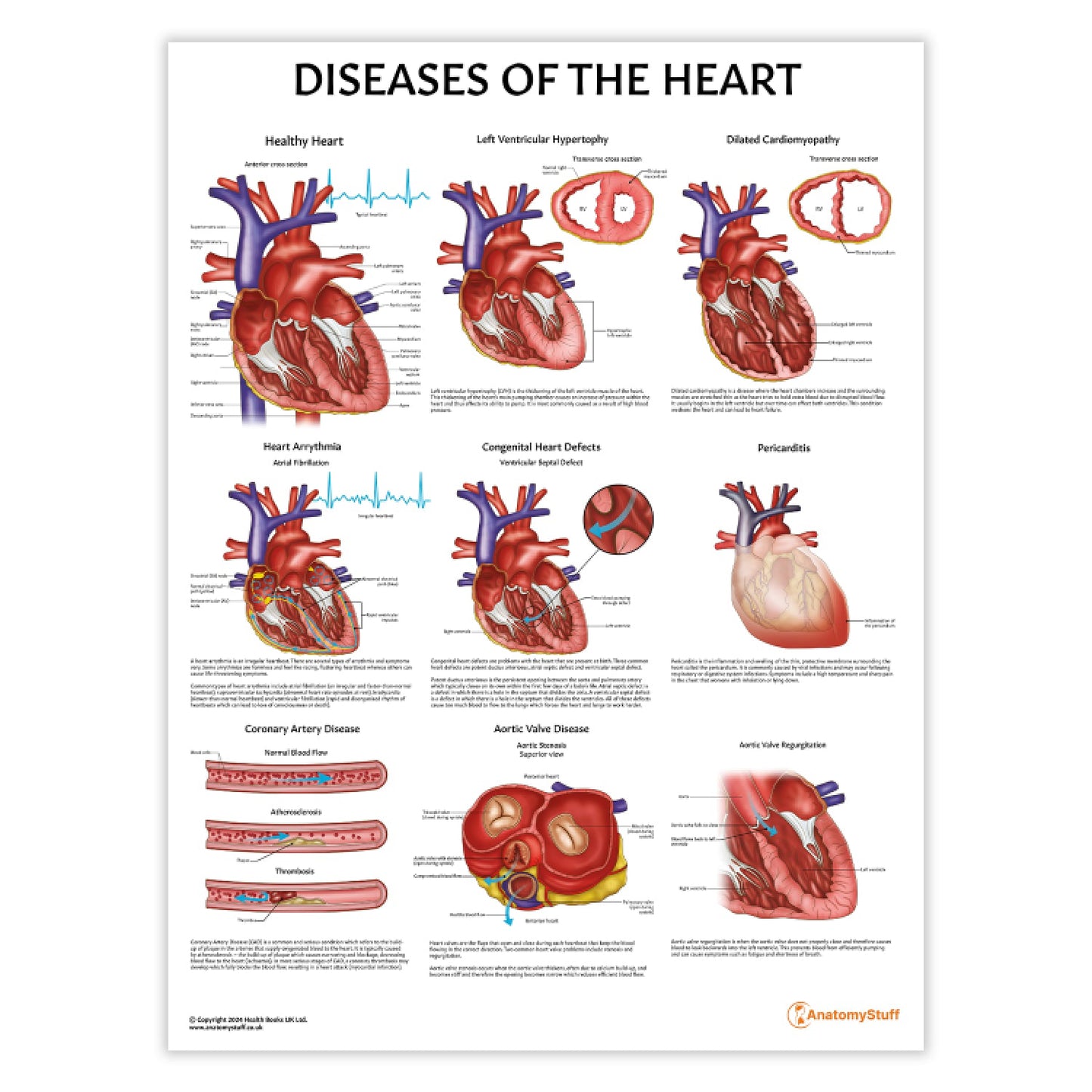 Diseases of the Heart Chart / Poster - Part of Collection