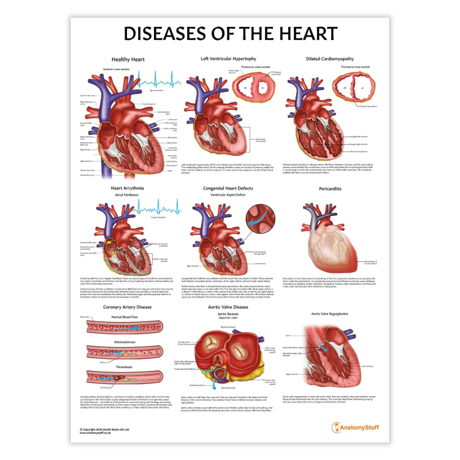Diseases of the Heart Chart / Poster - Part of Collection