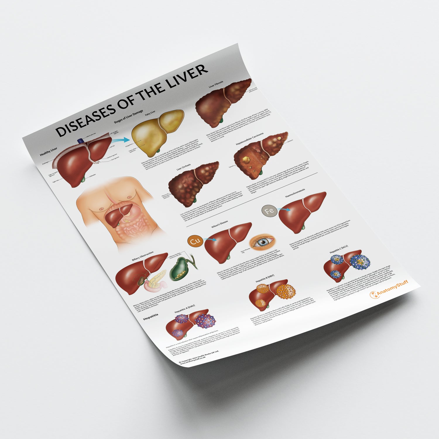 Diseases of the Liver Chart / Poster