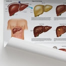 Switch Diseases of the Liver Chart / Poster 2 image
