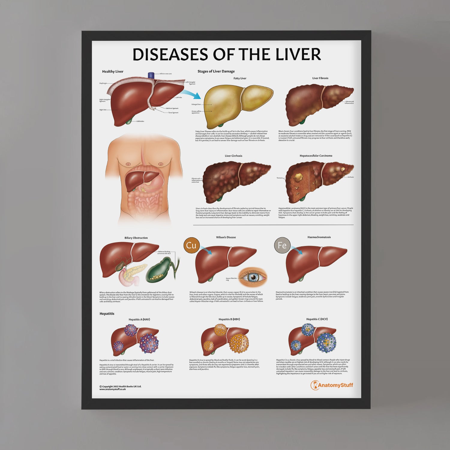 Diseases of the Liver Chart / Poster