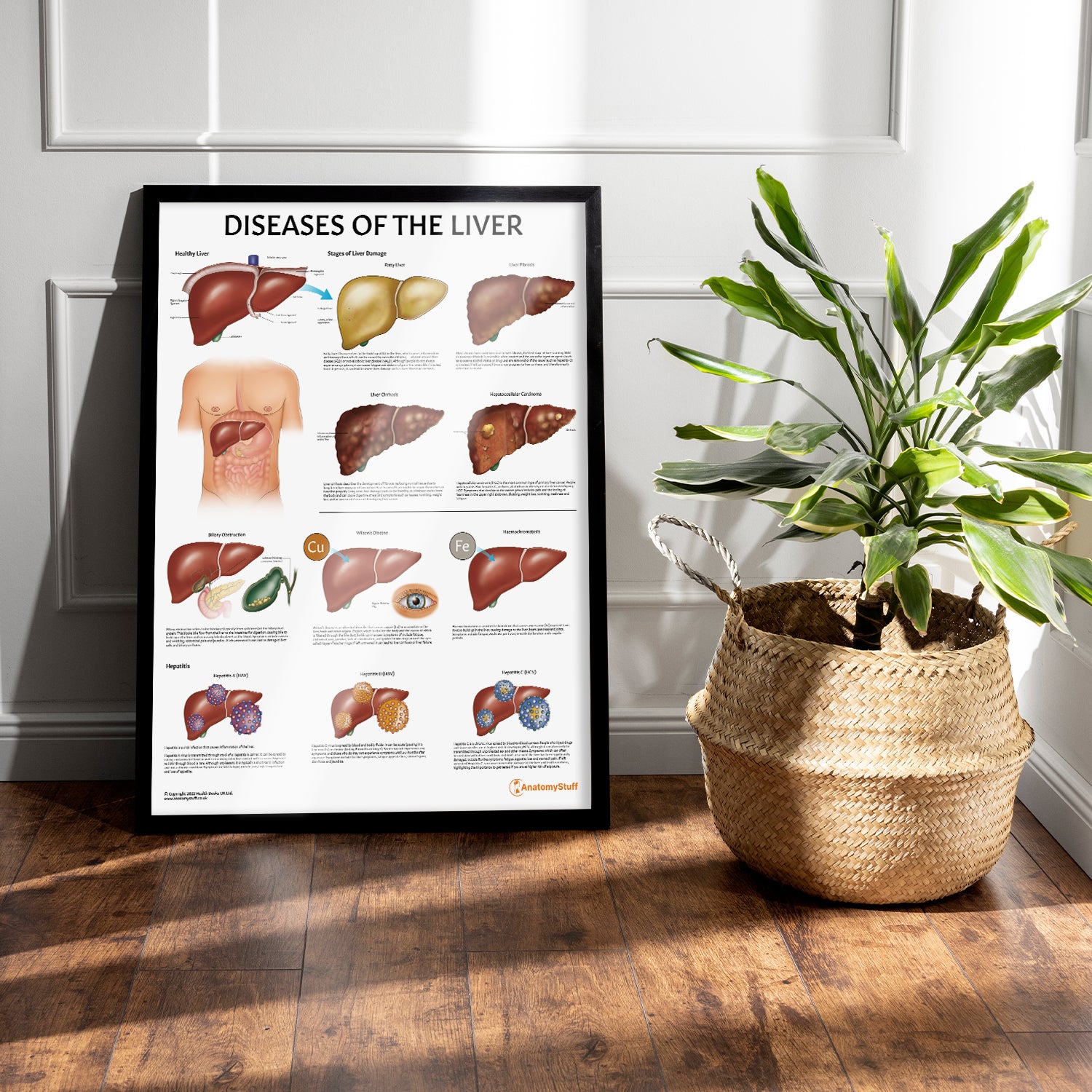 Diseases of the Liver Chart / Poster