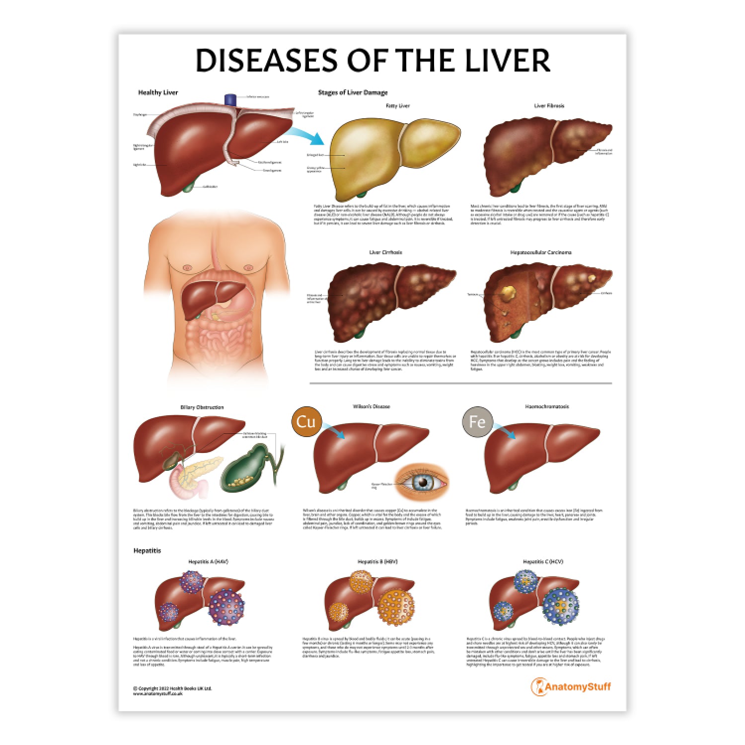 Diseases of the Liver Chart / Poster
