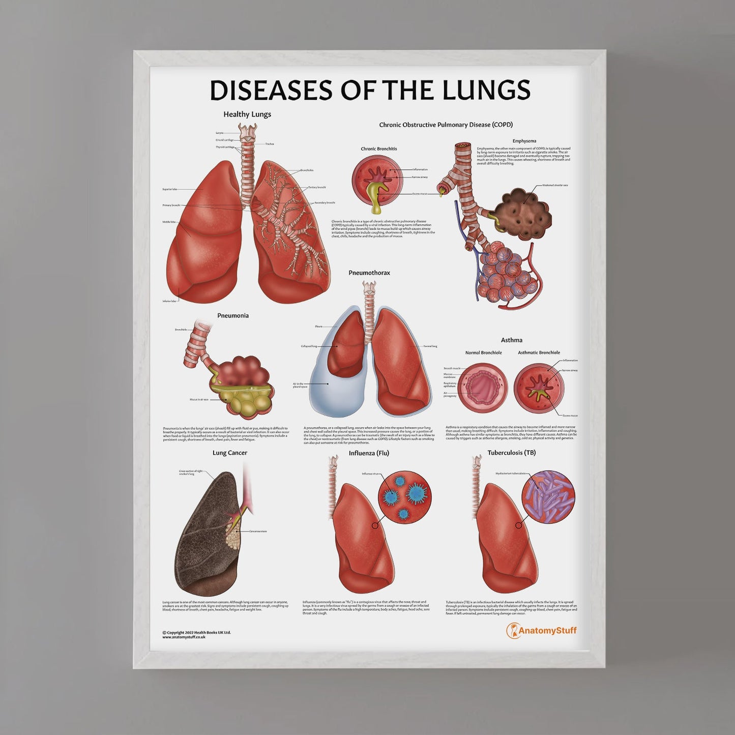Diseases of the Lungs Chart / Poster - Part of Collection