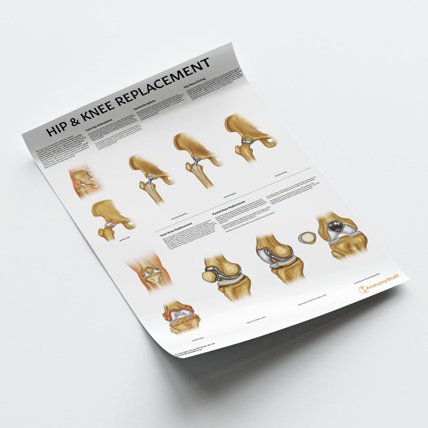 Hip & Knee Replacement Chart / Poster - Part of Collection