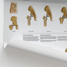 Switch Hip &amp; Knee Replacement Chart / Poster 2 image