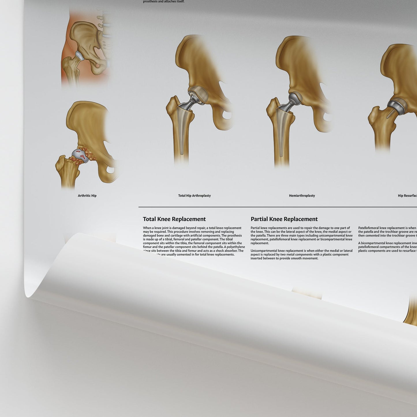 Hip & Knee Replacement Chart / Poster - Part of Collection
