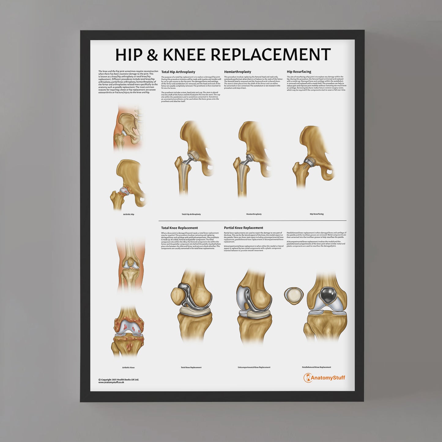 Hip & Knee Replacement Chart / Poster
