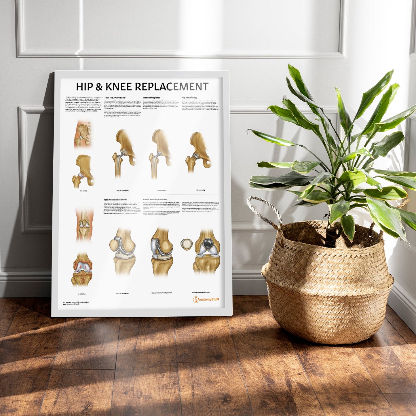 Hip & Knee Replacement Chart / Poster - Part of Collection