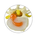 Switch The spinal models feature herniation, advanced osteoporosis and disc degeneration 3 image