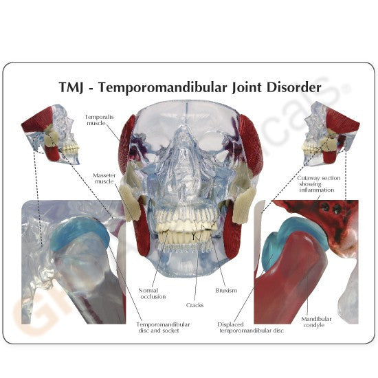 TMJ Disorder Model